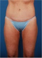 Body contouring for post pregnancy changes
