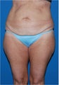 Body contouring for post pregnancy changes