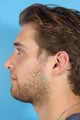 Rhinoplasty