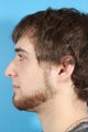 Rhinoplasty