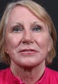68 year old woman treated with a facelift procedure