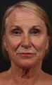 68 year old woman treated with a facelift procedure