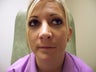 32 year old female, lip reconstruction