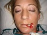 32 year old female, lip reconstruction
