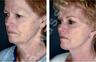 Complete Facial Rejuvenation