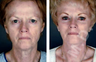 Complete Facial Rejuvenation