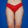Thigh Lift