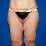 Thigh Lift
