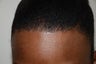 Hairline Advancement