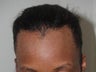 Hairline Advancement
