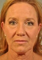Upper and Lower Blepharoplasty with a Hetter Peel