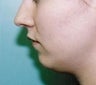 Female patient who underwent a chin implant 