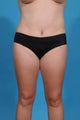 Mini-tummy tuck
