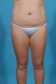 Mini-tummy tuck