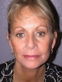 Facelift