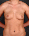 Breast Augmentation