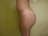 Brazilian Butt Lift