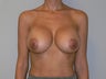 Breast Augmentation with Saline Implants