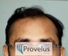 Norwood VI Hair Transplant