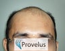 Norwood VI Hair Transplant