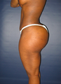 Brazilian Butt Lift 