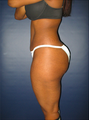 Brazilian Butt Lift 