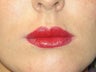 Lip augmentation with Juvederm