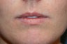 Lip augmentation with Juvederm