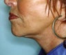 Neck Lift