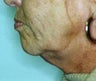 Neck Lift