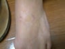 Tattoo Removal