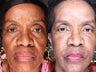 74 Year Old Female Fat Transfer To Face