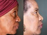 74 Year Old Female Fat Transfer To Face