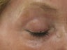Fraxel re:pair (repair) CO2 laser Bepharoplasty