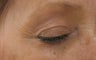 Fraxel re:pair (repair) CO2 laser Bepharoplasty