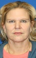 Facelift with Extended Necklift, Browlift, Upper Blepharoplasty, and Skin Pinch