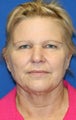 Facelift with Extended Necklift, Browlift, Upper Blepharoplasty, and Skin Pinch