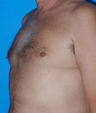 Gynecomastia 