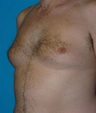 Gynecomastia 