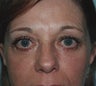 Eyelid Surgery