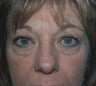 Eyelid Surgery
