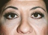 Ptosis Repair