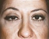 Ptosis Repair