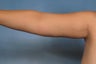 Arm Lift 