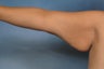 Arm Lift 