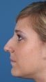 Rhinoplasty