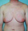 41-Year-Old Male Breast Reduction