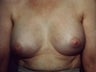 Female patient who underwent a breast reconstruction 