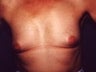 Female patient who underwent a breast reconstruction 