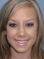 26 year old Caucasian American female for Rhinoplasty (nose job)